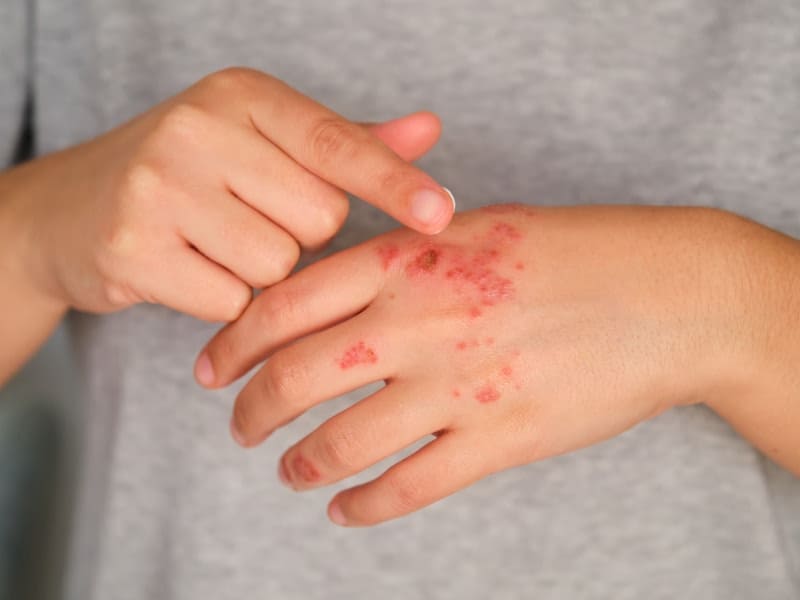 Psoriasis