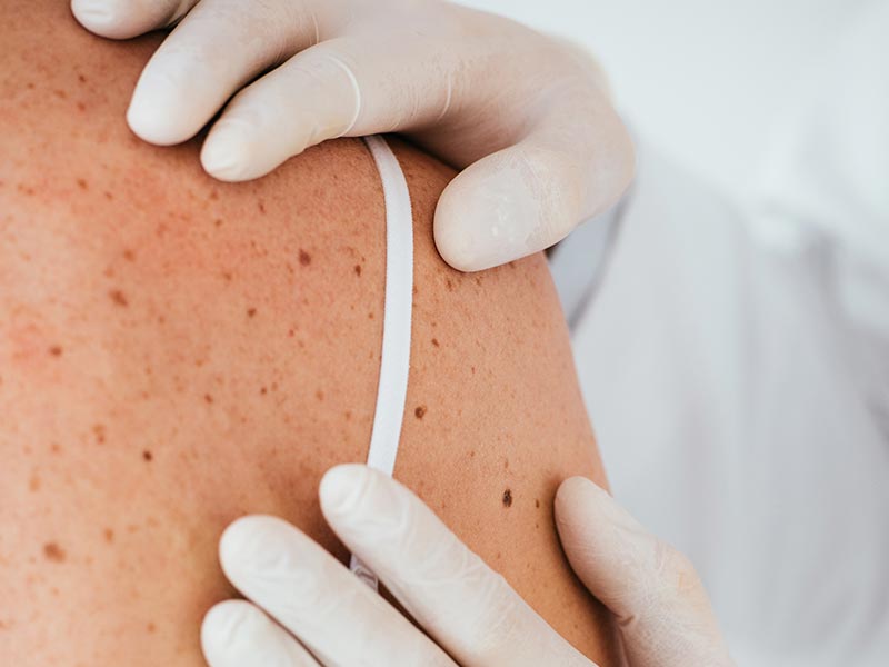 Actinic Keratosis