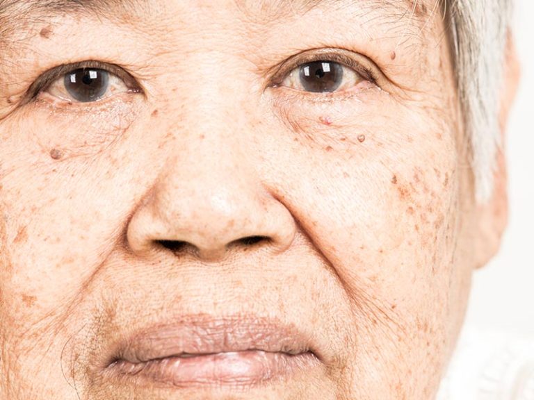 Age Spots