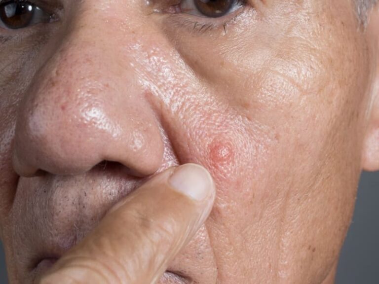 Basal Cell Carcinoma