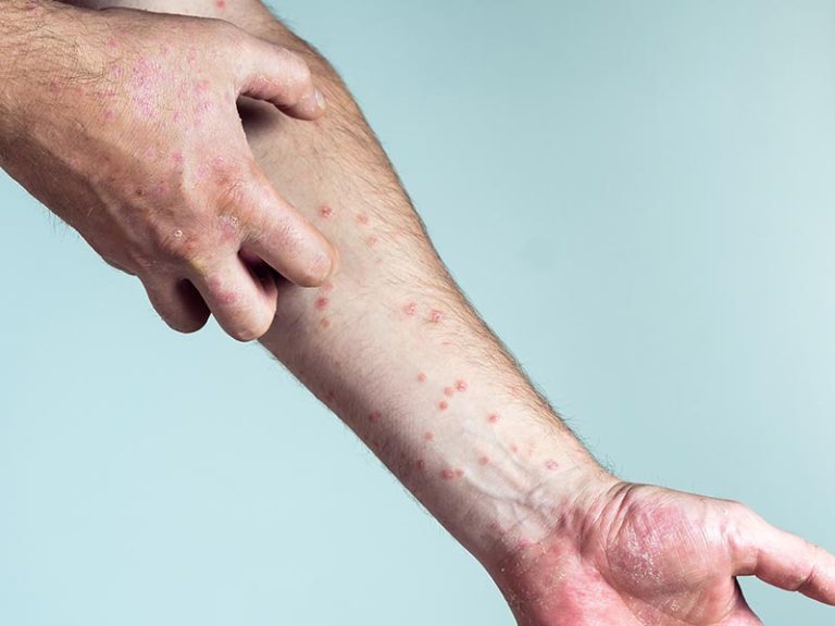 Contact Dermatitis