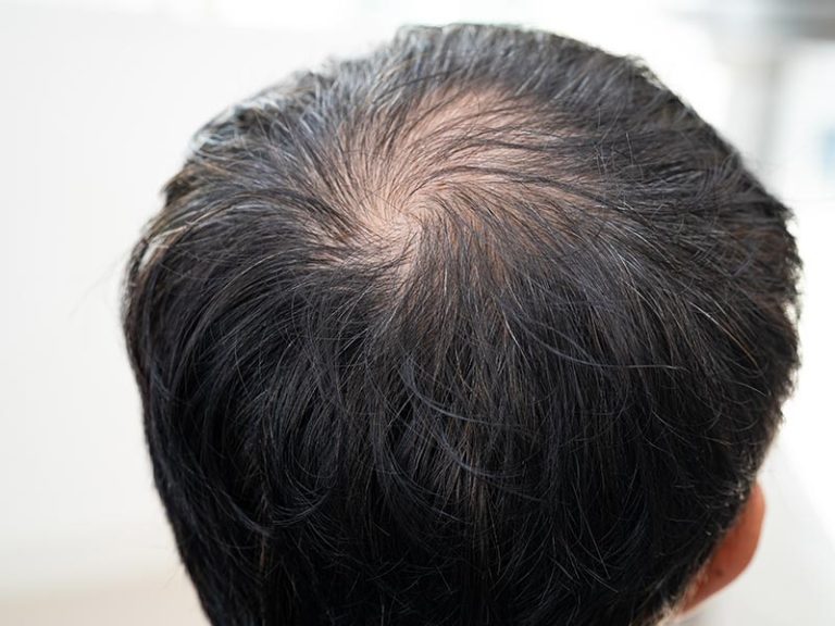 Hair Loss