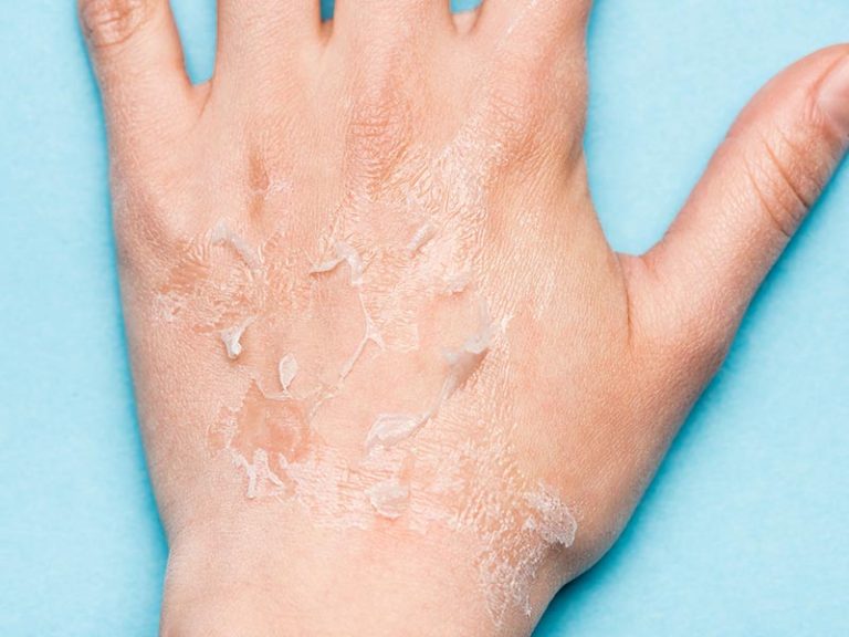 Hand Dermatitis