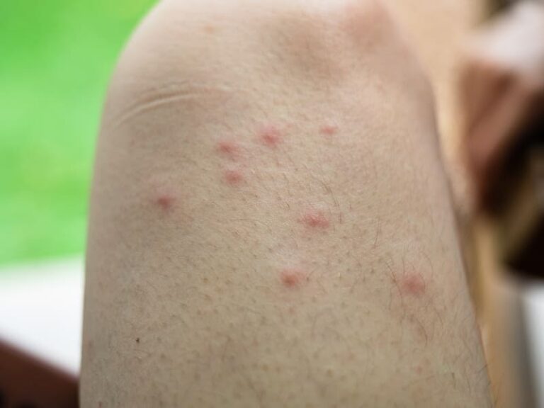 Hives
