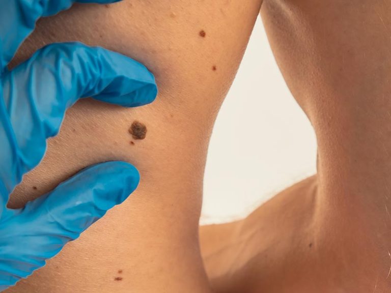 Melanoma