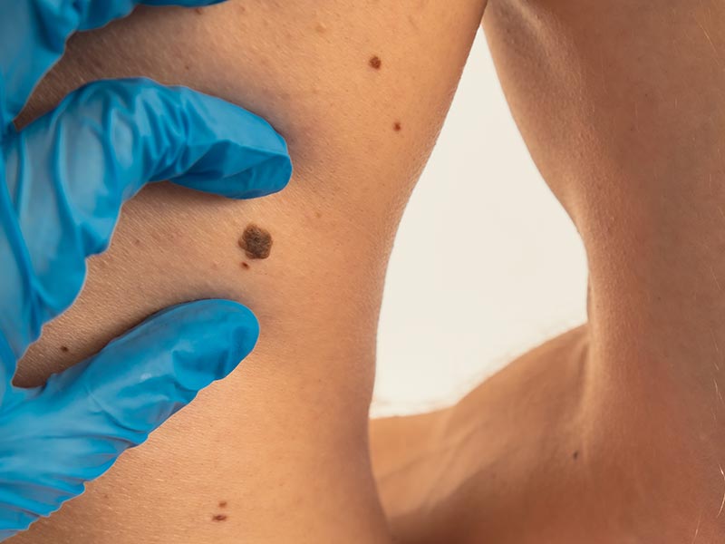 Melanoma