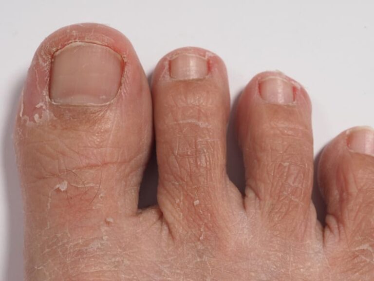 Mycotic Nail Infections