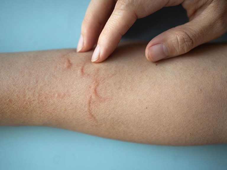 Pruritus