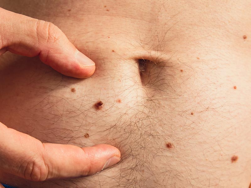 Scabies