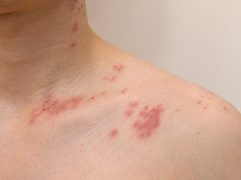 Shingles