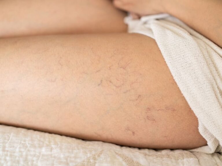 Spider Veins